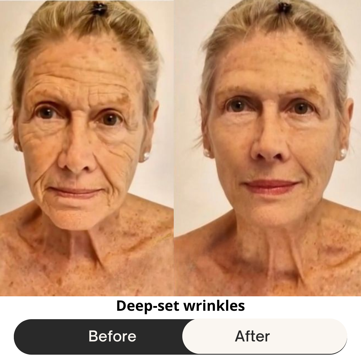 HEMIODERM - Instant Lift - Anti-Aging
