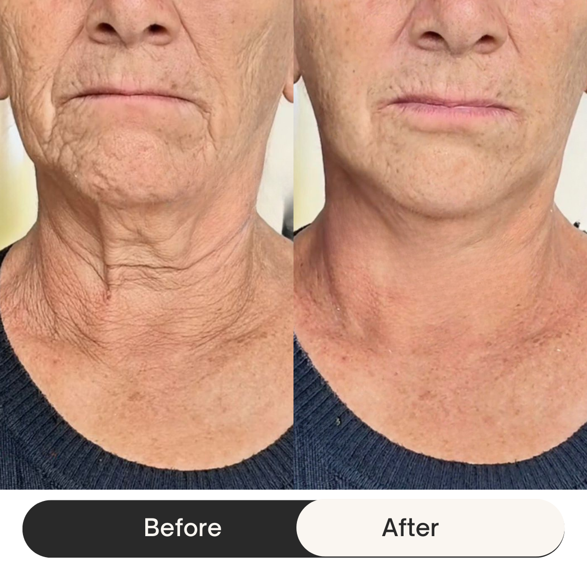 HEMIODERM - Instant Lift - Anti-Aging