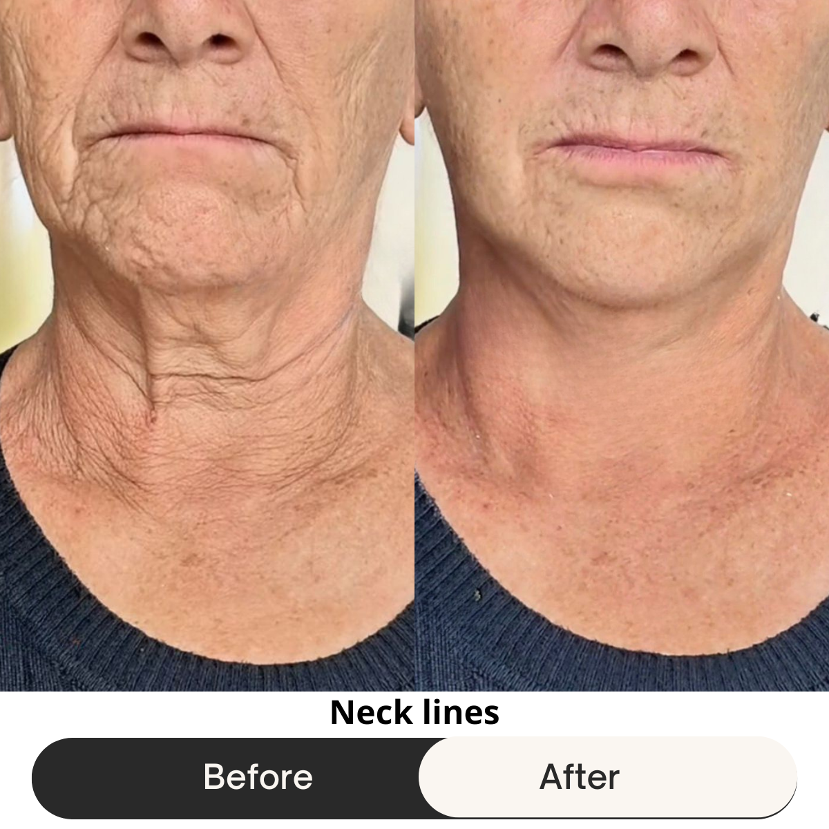 HEMIODERM - Instant Lift - Anti-Aging