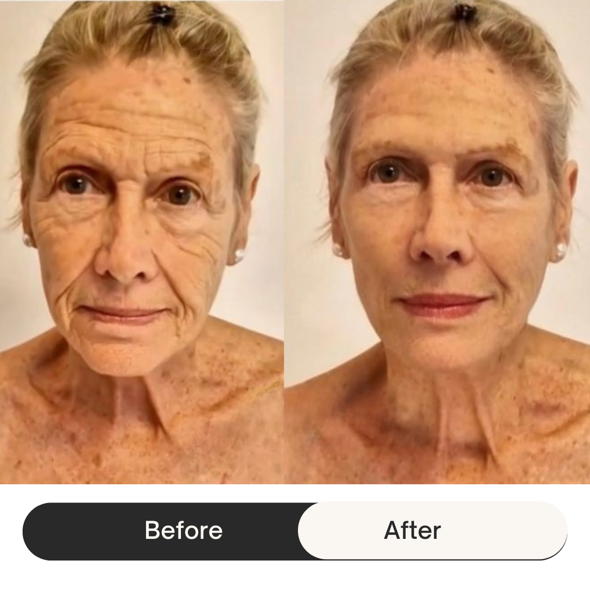 HEMIODERM - Instant Lift - Anti-Aging